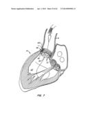 Retrievable Heart Valve Anchor and Method diagram and image