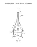 Retrievable Heart Valve Anchor and Method diagram and image