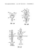 Retrievable Heart Valve Anchor and Method diagram and image