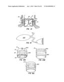 Retrievable Heart Valve Anchor and Method diagram and image