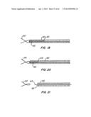 Retrievable Heart Valve Anchor and Method diagram and image