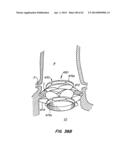 Retrievable Heart Valve Anchor and Method diagram and image