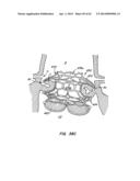 Retrievable Heart Valve Anchor and Method diagram and image