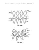 Retrievable Heart Valve Anchor and Method diagram and image