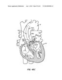 Retrievable Heart Valve Anchor and Method diagram and image