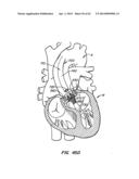 Retrievable Heart Valve Anchor and Method diagram and image