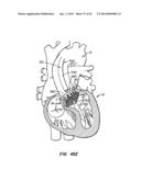Retrievable Heart Valve Anchor and Method diagram and image
