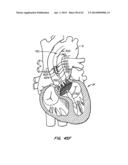 Retrievable Heart Valve Anchor and Method diagram and image