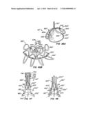 Retrievable Heart Valve Anchor and Method diagram and image