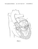 TISSUE ANCHORS, SYSTEMS AND METHODS, AND DEVICES diagram and image