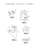 TRANSVENTRICULAR IMPLANT TOOLS AND DEVICES diagram and image