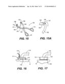 TRANSVENTRICULAR IMPLANT TOOLS AND DEVICES diagram and image