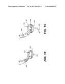 TRANSVENTRICULAR IMPLANT TOOLS AND DEVICES diagram and image