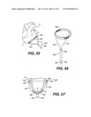 TRANSVENTRICULAR IMPLANT TOOLS AND DEVICES diagram and image