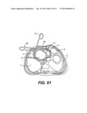 TRANSVENTRICULAR IMPLANT TOOLS AND DEVICES diagram and image