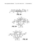 TRANSVENTRICULAR IMPLANT TOOLS AND DEVICES diagram and image