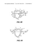 TRANSVENTRICULAR IMPLANT TOOLS AND DEVICES diagram and image