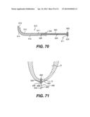 TRANSVENTRICULAR IMPLANT TOOLS AND DEVICES diagram and image