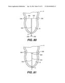 TRANSVENTRICULAR IMPLANT TOOLS AND DEVICES diagram and image