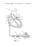 METHOD OF CLOSING AN OPENING IN A WALL OF THE HEART diagram and image