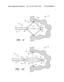 METHOD OF CLOSING AN OPENING IN A WALL OF THE HEART diagram and image