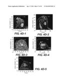 Dynamic MR Imaging of Patients with Breast Cancer -- Establishment and     Comparison of Different Analytical Methods for Tissue Perfusion and     Capillary Permeability diagram and image