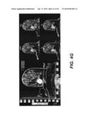 Dynamic MR Imaging of Patients with Breast Cancer -- Establishment and     Comparison of Different Analytical Methods for Tissue Perfusion and     Capillary Permeability diagram and image