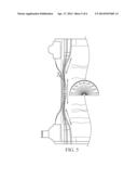 Combined Leg Cuff and Leg Gather diagram and image