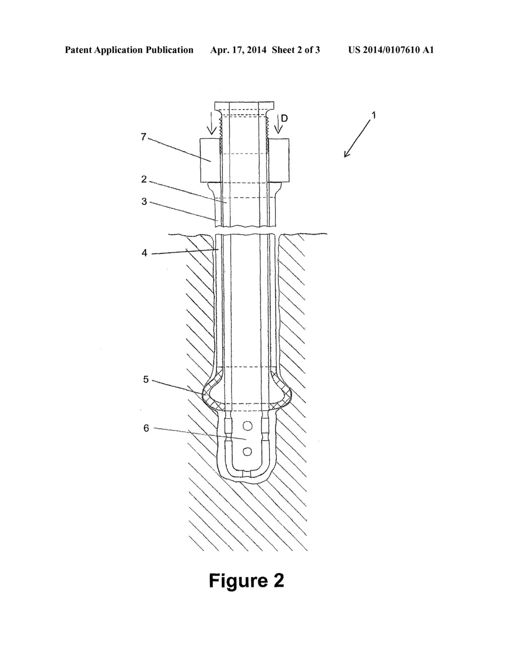 MEDICAL CATHETER WITH REDUCED BACKFLOW - diagram, schematic, and image 03