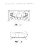 Intraoral Discluding Appliance diagram and image
