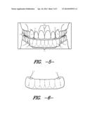 Intraoral Discluding Appliance diagram and image