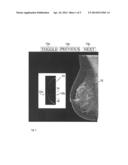 Breast Tomosynthesis with Display of Highlighted Suspected Calcifications diagram and image