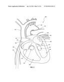 VENTRICULAR ASSIST DEVICE AND RELATED METHODS diagram and image