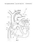 VENTRICULAR ASSIST DEVICE AND RELATED METHODS diagram and image