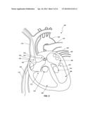 VENTRICULAR ASSIST DEVICE AND RELATED METHODS diagram and image