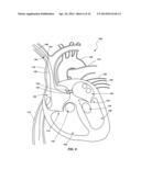 VENTRICULAR ASSIST DEVICE AND RELATED METHODS diagram and image