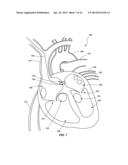 VENTRICULAR ASSIST DEVICE AND RELATED METHODS diagram and image