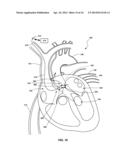 VENTRICULAR ASSIST DEVICE AND RELATED METHODS diagram and image