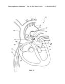 VENTRICULAR ASSIST DEVICE AND RELATED METHODS diagram and image