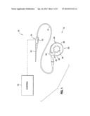 HYDRAULIC-MECHANICAL GASTRIC BAND diagram and image