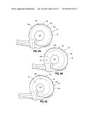 HYDRAULIC-MECHANICAL GASTRIC BAND diagram and image