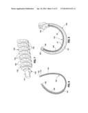 HYDRAULIC-MECHANICAL GASTRIC BAND diagram and image