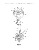 HYDRAULIC-MECHANICAL GASTRIC BAND diagram and image