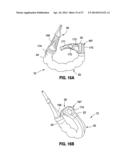 HYDRAULIC-MECHANICAL GASTRIC BAND diagram and image