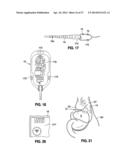 HYDRAULIC-MECHANICAL GASTRIC BAND diagram and image