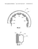 HYDRAULIC-MECHANICAL GASTRIC BAND diagram and image