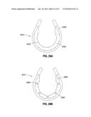 HYDRAULIC-MECHANICAL GASTRIC BAND diagram and image