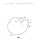 HYDRAULIC-MECHANICAL GASTRIC BAND diagram and image