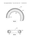 HYDRAULIC-MECHANICAL GASTRIC BAND diagram and image