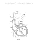 Complex Shape Steerable Tissue Visualization and Manipulation Catheter diagram and image